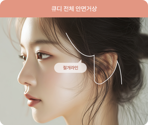 큐디 전체 안면거상