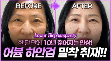 [어븀 하안검 찐후기] 눈밑 처짐과 …